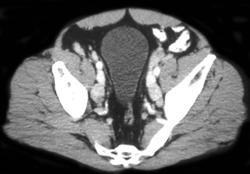 Pelvic Adenopathy - CTisus CT Scan