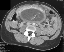 Pregnant Uterus - CTisus CT Scan