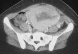 Postpartum Uterus - CTisus CT Scan