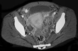 Pelvic inflammatory disease (PID) - CTisus CT Scan