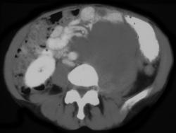 Uterine Sarcoma - CTisus CT Scan