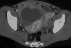 Tubo-ovarian Abscess - CTisus CT Scan