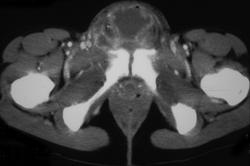 Abscess-involves Labia - CTisus CT Scan