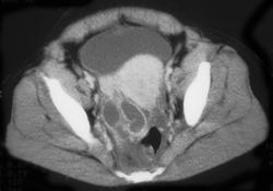 Pyosalpinx - CTisus CT Scan