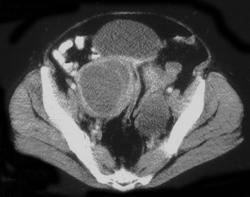 Tubo-ovarian Abscesses - CTisus CT Scan