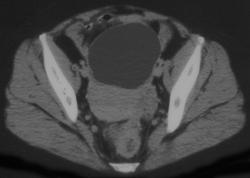 Endometrioma - CTisus CT Scan