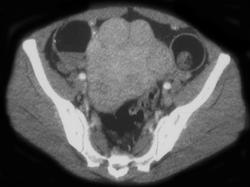 Dermoids - CTisus CT Scan