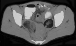 Ovarian Dermoid - CTisus CT Scan