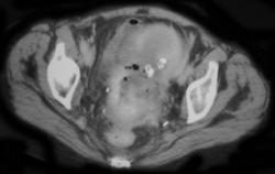 Invasive Cervical Cancer - CTisus CT Scan