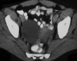 Ovarian Cancer With Carcinomatosis - CTisus CT Scan