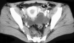 Endometriomas - CTisus CT Scan