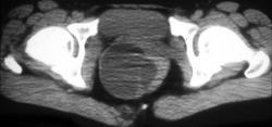 Bartholin Cyst - CTisus CT Scan