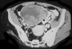 Uterine Leiomyosarcoma - CTisus CT Scan