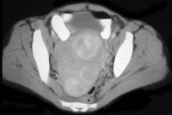 Uterine Fibroids - CTisus CT Scan