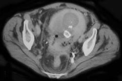 Cancer of the Cervix With Fistulae to Bladder - CTisus CT Scan