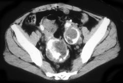 Calcified Masses-(ovarian Cancer) - CTisus CT Scan