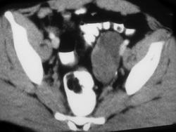 Ovarian Cystadenoma - CTisus CT Scan