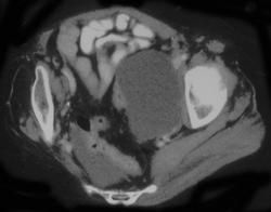 Lymphocele - CTisus CT Scan