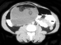 Dermoid - CTisus CT Scan