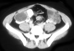 Hydatiform Mole With Enlarged Ovaries - CTisus CT Scan