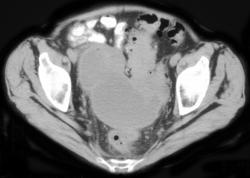 Pelvic Abscess - CTisus CT Scan