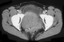 Fibroids - CTisus CT Scan