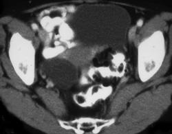 Ovarian Cyst - CTisus CT Scan