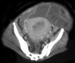 Tubovarian Abscess - CTisus CT Scan