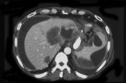 Carcinomatosis Due to Ovarian Cancer - CTisus CT Scan