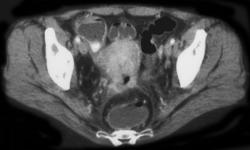 Cervical Cancer (iiib) - CTisus CT Scan