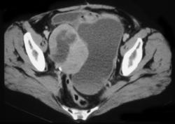 Krukenberg Tumor - CTisus CT Scan