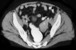 Brenner Tumor - CTisus CT Scan