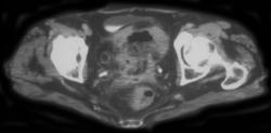 Fistulae Uterus to Bladder - CTisus CT Scan