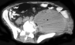 Recurrent Cervical Cancer - CTisus CT Scan