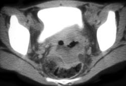 Ulcerating Cervical Cancer - CTisus CT Scan