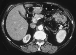 Ovarian Cancer With Implants on Bowel - CTisus CT Scan