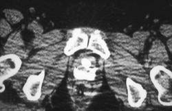 Fistulae From Bladder to Vagina - CTisus CT Scan