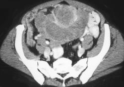 Ovarian Carcinoma - CTisus CT Scan