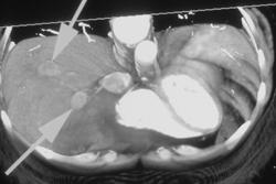 Implants on the Right Hemidiaphragm - CTisus CT Scan