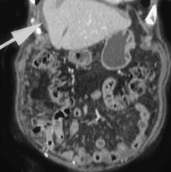 Carcinomatosis - CTisus CT Scan