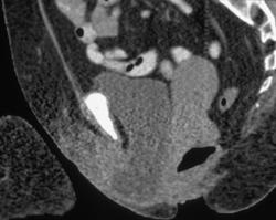 Prolapse of the Bladder - CTisus CT Scan