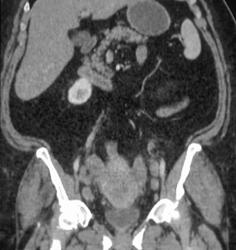 Obturator Nodes in Cervical Cancer - CTisus CT Scan