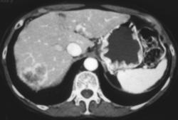 Metastases to the Liver From Endometrial Cancer - CTisus CT Scan