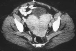 Absent Left Kidney With Bicornuate Uterus - CTisus CT Scan