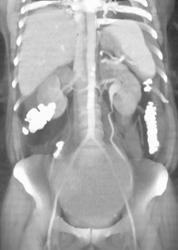 Ovarian Cancer and Ovarian Teratoma - CTisus CT Scan