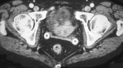 Pessary - CTisus CT Scan