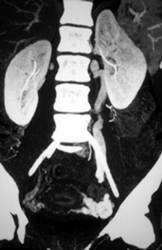 Pelvic Congestion Syndrome - CTisus CT Scan