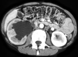 Cervical Cancer With Hydronephrosis - CTisus CT Scan