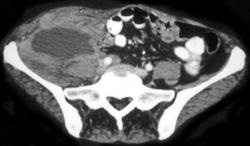 Recurrent Ovarian Cancer - CTisus CT Scan