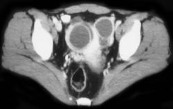 Tubo-ovarian Abscesses (TOA) - CTisus CT Scan